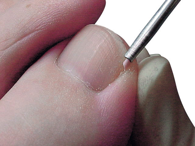 Protecteurs Sulci - 100 pièces - Ruck