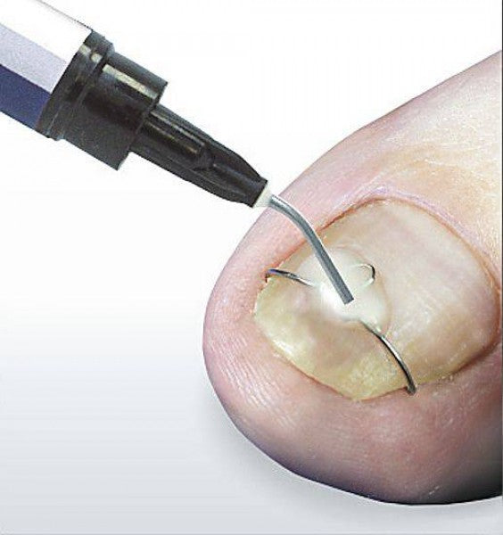 Blue Light Gel pour orthonyxies - Unguisan